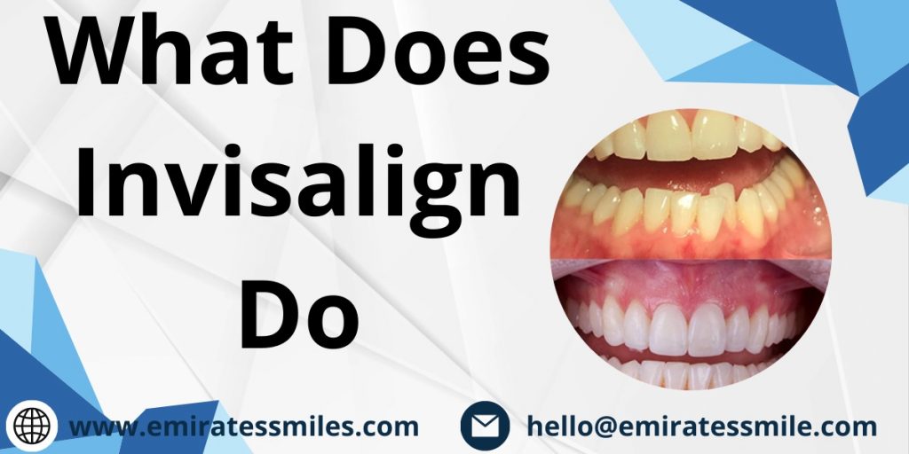 What Does Invisalign Do